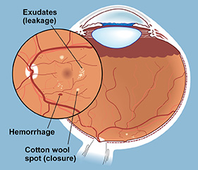 Diabetic retinopathy is the change that occurs in the blood vessels in the retina due to the abnormal blood sugar levels and other factors associated with diabetes mellitus.