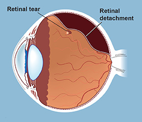 Retinal Detachment - Vitreo-Retinal Consultants