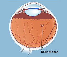 A retinal tear occurs when the vitreous gel collapses and pulls away from the front surface of the retina. 